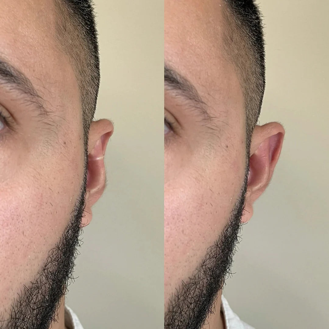 Natural Ear Correction Clip – Instantly Fix Protruding Ears Without Surgery 👂✨