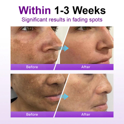 🌟SEAGRIL® 𝐒𝐩𝐨𝐭𝐄𝐫𝐚𝐬𝐞 𝐏𝐫𝐨𝐛𝐢𝐨𝐭𝐢𝐜 𝐒𝐡𝐢𝐞𝐥𝐝 𝐒𝐞𝐫𝐮𝐦 – Fades Dark Spots, Evens Skin Tone & Boosts Radiance✨💜