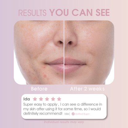 🎄✨ RIKO Miracle Acne Erase Red & Blue Light Therapy Patch – Dermatologist-Approved, Painless Blemish Removal ✨🎄